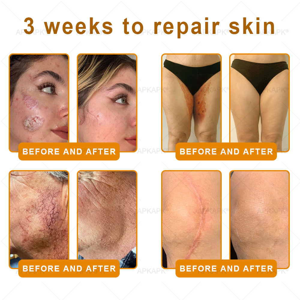 APKAPK®--Only 10 jars! Grab an exclusive 30% discount now! Keep your skin youthful and glowing in just 1 to 3 weeks. Don’t miss your chance—this offer won’t come around again until next year. Act fast! 180-day money back guarantee!
